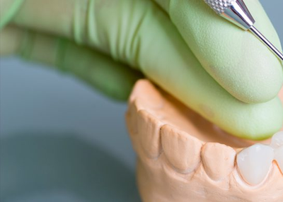 6 Things to Consider in Getting Tooth Crowns