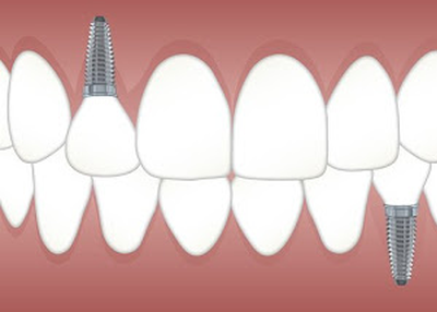 Dental implants Merced CA
