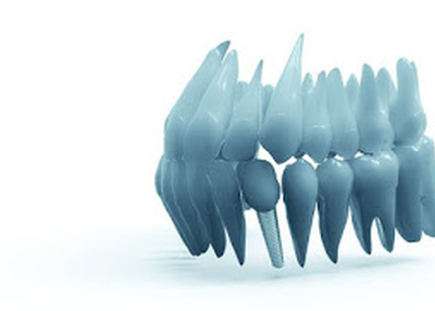 Dental implants Merced CA