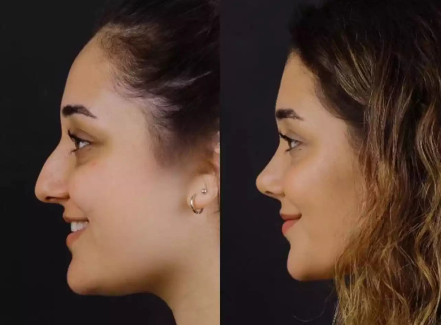 Are There Any Alternatives to Nose Deviated Septum Surgery in Dubai?