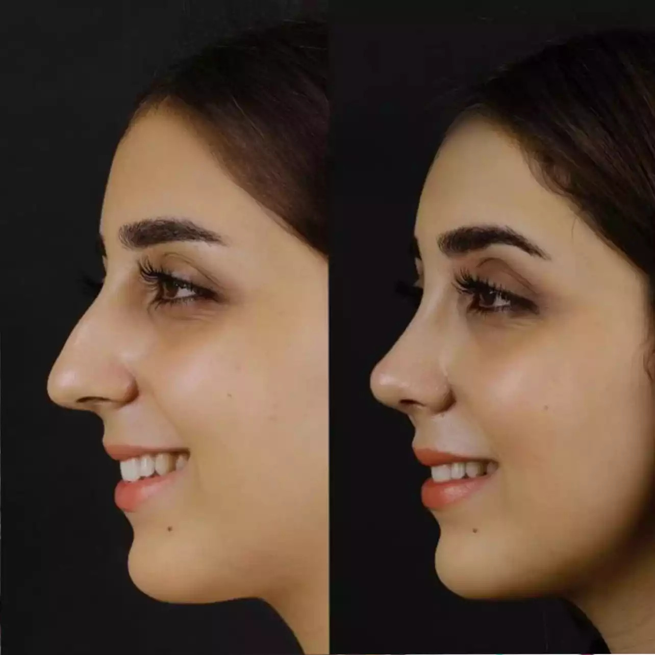 Septoplasty in Dubai for Lasting Comfort