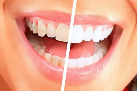 Is Teeth Whitening In Barangaroo The Secret To A Brighter, More Confident Smile?