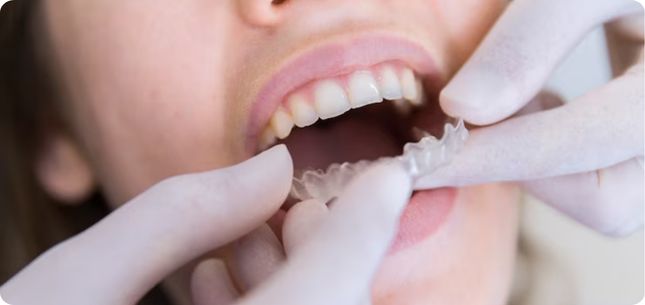 Orthodontics and TMJ: Can Braces Help with Jaw Pain?