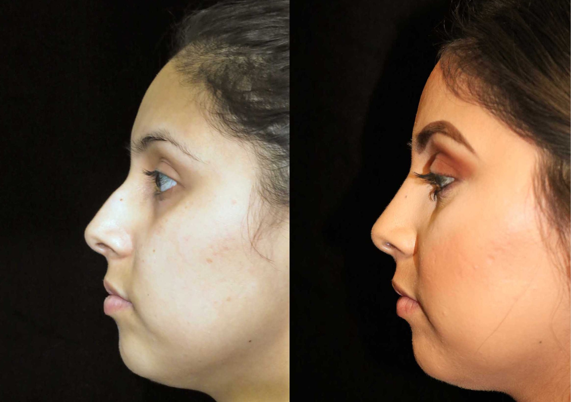 جمالك يبدأ من هنا: نتائج تجميل الأنف قبل وبعد