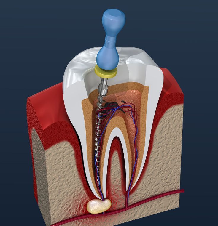 Root Canal for Infected Teeth: Signs You Shouldn’t Ignore